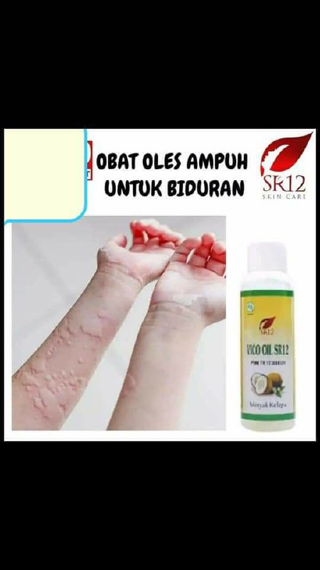 Punya masalah seperti ini?gak kunjung sembuh?malah telinga makin terasa pekak karna kbanyakan minum obat kimiaKata orang tua zaman dulu, hati2 jangan sampai naik ke lidah, karena lidah bisa kelu/kaku yang akhirnya bisa