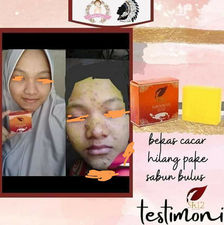 Bekas cacar hilang dan Kulit kembali mulus dengan rutin pakai  sabun bulus SR12 ...MaasyaAllah...🌴💥BULUS SOAP💥🌴No BPOM : NA18170500214Netto : 60grSabun bulus mengandung turtle oil dan cocos nucifera oil yang kaya akan vit A,  C dan Vit E,  bermanfaat untuk mengencangkan, menghaluskan kulit,  mencerahkan, melembabkan dan membantu mengurangi stretch mark pada kulit.  Dapat di gunakan pada wajah dan tubuh*Sabun ini cocok untuk jenis kulit normal, berminyak, dan Kombinasi cenderung berminyak Noted : Bagi sebagian orang yang memiliki kulit kering, sabun ini cocok. (Tergantung Rekasi setiap kulitnya masing-masing).Wa/telegram 👉0821-5799-8873AGEN RESMI SR12 HERBAL SKINCARE BALIKPAPAN
