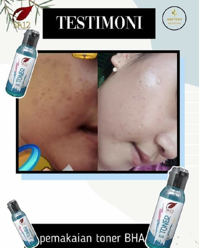 Toner BHA rekomended banget bagi kamu yang punya jerawat bruntus, Selain efektif menghempaskan jerawat  kulitmu juga  jadi cerah alami glowing semriwinggg bebas kusam 👍👍👍Ready stok ya.Buruan dipinang ...WA/telegram 👉 0821-5799-8873AGEN RESMI SR12 HERBAL SKINCARE BALIKPAPAN KAL-TIMMampir ke shopeeku yuks 👇shopee.co.id/agenresmisr12Atautokopedia.com/sr12balikpapanToner BHA rekomended banget bagi kamu yang punya jerawat bruntus, Selain efektif menghempaskan jerawat  kulitmu juga  jadi cerah alami glowing semriwinggg bebas kusam 👍👍👍Ready stok ya.Buruan dipinang ...WA/telegram 👉 0821-5799-8873AGEN RESMI SR12 HERBAL SKINCARE BALIKPAPAN KAL-TIMMampir ke shopeeku yuks 👇shopee.co.id/agenresmisr12Atautokopedia.com/sr12balikpapan