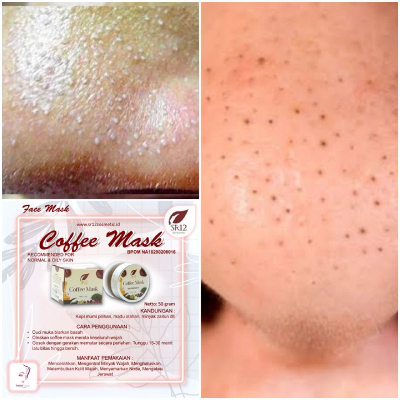 Mau whitehead (komedo putih) ataupun blackhead (komedo hitam ) Coffee Mask peeling SR12 mampu hempaskan semua komedo-komedo tersebut tanpa rasa sakit, hanya dengan 