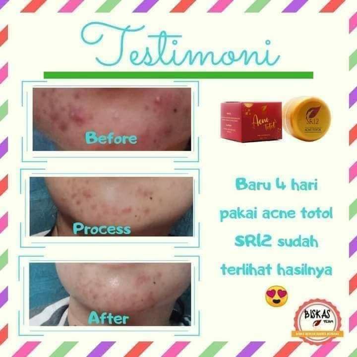 🌿ACNE TOTOL SR12 ACNE TOTOL solusi sehat untuk  jerawat bulanan. Apa itu mbak? Itu lo jerawat yg muncul saat menjelang haid atau sedang haid😁 Acne Totol juga bisa mengatasi jerawat Hormon lainnya ya seperti jerawat yg muncul ketika sedang stress juga karena wajah yg kotor yang malas di cleansing (dibersihkan)😅Setiap kali datang bulan si dia pasti ikutan nongol.Ini lah yg nama nya jerawat hormonPertanda kulit wajah anda sehatKarena kulit yg sehat masih merespon dengan baik saat ada perubahan hormon dalam diriEntah itu karena haid,stress atau saat kulit kotor, na...kalau jerawat hormon ini muncul, totolin aja dengan ACNE TOTOL SR12 🤩 totolin nya tiap 3 jam sekali ya,  tepat pada jerawatnya saja ya..dijamin langsung kering ngelupas sendiri tanpa bekas hitam,okey😁Acne Totol SR12, Si pemburu jerawat Hormon🤩Ready stock ❤️Wa/telegram 👉0821-5799-8873Agen Resmi SR12 Herbal Skin care Balikpapan, Kal-Tim🌿ACNE TOTOL SR12 ACNE TOTOL solusi sehat untuk  jerawat bulanan. Apa itu mbak? Itu lo jerawat yg muncul saat menjelang haid atau sedang haid😁 Acne Totol juga bisa mengatasi jerawat Hormon lainnya ya seperti jerawat yg muncul ketika sedang stress juga karena wajah yg kotor yang malas di cleansing (dibersihkan)😅Setiap kali datang bulan si dia pasti ikutan nongol.Ini lah yg nama nya jerawat hormonPertanda kulit wajah anda sehatKarena kulit yg sehat masih merespon dengan baik saat ada perubahan hormon dalam diriEntah itu karena haid,stress atau saat kulit kotor, na...kalau jerawat hormon ini muncul, totolin aja dengan ACNE TOTOL SR12 🤩 totolin nya tiap 3 jam sekali ya,  tepat pada jerawatnya saja ya..dijamin langsung kering ngelupas sendiri tanpa bekas hitam,okey😁Acne Totol SR12, Si pemburu jerawat Hormon🤩Ready stock ❤️Wa/telegram 👉0821-5799-8873Agen Resmi SR12 Herbal Skin care Balikpapan, Kal-Tim