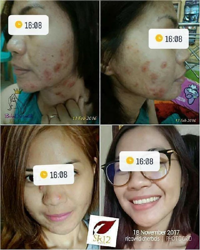 SR12 tidak merubah warna kulitmu, SR12 tidak  menjanjikan kulitmu putih tapi SR12 membuat kulit mu sehat cerah alami.Wajah SR12 itu cerah Alami guysss..., putih nya bukan putih pucat, bukan licin 🤗 nggak ngelupas merah2🤭, wajah SR12 itu wajah Herbal alami, perawatan SR12 HERBAL SKINCARE itu mengembalikan kecantikan alami kulitmu, mengeluarkan racun-racun atau zat2 kimia berbahaya lainnya yg menumpuk di wajahmu, memutus siklus ketergantungan terhadap kosmetik sebelumnya, mencerahkan secara maksimal sesuai warna asli kulit kita.Beauty is not a dream,  Bringing back your beauty 🥰Order atau konsultasi(free):Wa/telegram 👉0821-5799-8873AGEN RESMI SR12 HERBAL SKINCARE BALIKPAPAN, KAL-TIM Insyaallah FAST RESPON 🤩🤩🤩SR12 tidak merubah warna kulitmu, SR12 tidak  menjanjikan kulitmu putih tapi SR12 membuat kulit mu sehat cerah alami.Wajah SR12 itu cerah Alami guysss..., putih nya bukan putih pucat, bukan licin 🤗 nggak ngelupas merah2🤭, wajah SR12 itu wajah Herbal alami, perawatan SR12 HERBAL SKINCARE itu mengembalikan kecantikan alami kulitmu, mengeluarkan racun-racun atau zat2 kimia berbahaya lainnya yg menumpuk di wajahmu, memutus siklus ketergantungan terhadap kosmetik sebelumnya, mencerahkan secara maksimal sesuai warna asli kulit kita.Beauty is not a dream,  Bringing back your beauty 🥰Order atau konsultasi(free):Wa/telegram 👉0821-5799-8873AGEN RESMI SR12 HERBAL SKINCARE BALIKPAPAN, KAL-TIM Insyaallah FAST RESPON 🤩🤩🤩