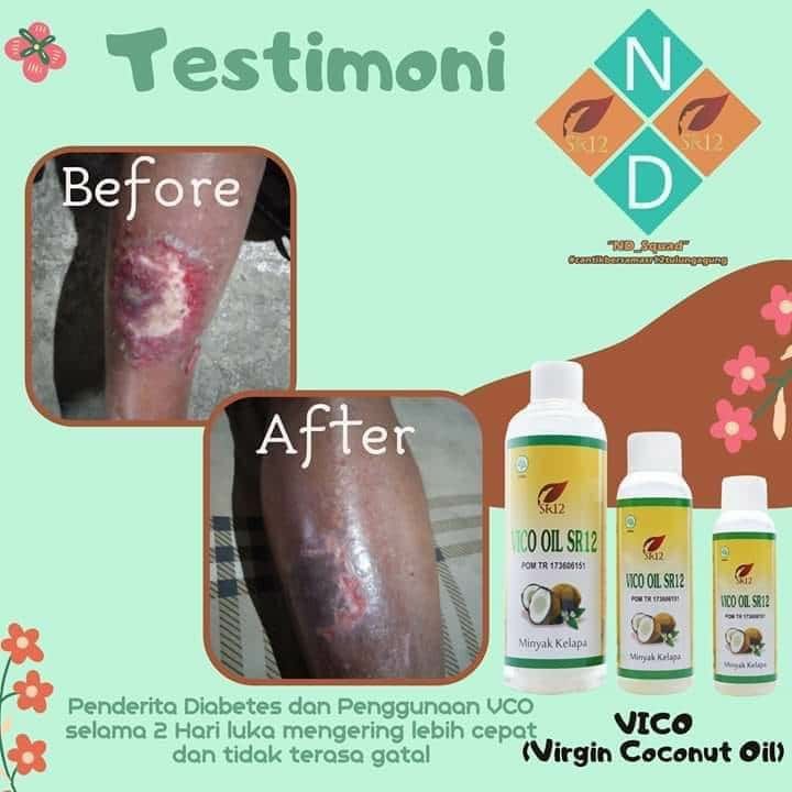 Biidznillah, luka diabetes mengering dan tidak terasa gatal setelah konsumsi VCO SR12 selama 2 hariMaasyaAllah...Minyak kelapa murni (VCO SR12)adalah minyak sejuta Manfaat. Kenapa mesti pilih VCO SR12 ?Karena VCO SR12 itu diproses dengan tehnik cold press (tanpa pemanasan) tanpa pemanasan matahari maupun kompor..Sehingga menghasilkan VCO (minyak kelapa murni) dengan kualitas terbaikVCO SR12 Itu bening, tidak keruh, tidak tengik..minyak sejuta manfaat, baik untuk kecantikan maupun kesehatan serta kuliner🤩Ready stock ya 🤩🤩🤩Wa/telegram 👉0821-5799-8873Agen Resmi SR12 Herbal Skin care Balikpapan, Kal-TimAtau silahkan kunjungi toko online kami di👇