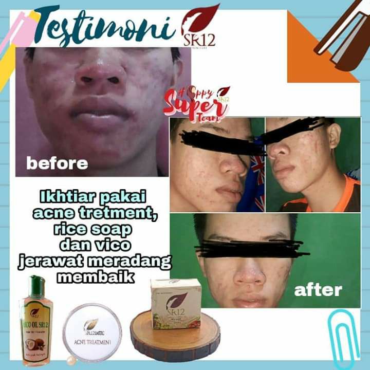 Pakai sabun beras (rice soap), acne treatment dan vco, hasil nya perlahan mulai terlihat. MasyaAllah👍👍👍 laki bisa pake SR12 juga Lo...bukan cuman perempuan aja...💐💐💐