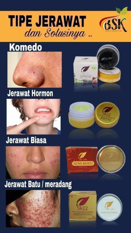 Di SR12 itu Setiap jenis jerawat masing2 punya solusi.sehingga tidak seperti obat jerawat yang lain yang terkadang jerawat and kulit wajah tekupas semua hingga tampak putih pucat, terkadang pula kulit sekitar sudah bersih putih tapi  jerawat masih meninggalkan bekas merah terkadang bekas hitam-hitam No no no insyaAllah di SR12 nggak seperti itu ya, di SR12 kulit wajah akan kembali normal seperti sediakala warna asli kulitmu bahkan  lebih sehat cerah alami🥰🤩😎ORDER/KONSULTASI (Free)Wa/telegram 👉0821-5799-8873AGEN RESMI SR12 HERBAL SKINCARE BALIKPAPAN, KAL-TIMAtau silahkan kunjungi toko online kami di👇shopee.co.id/agenresmisr12Atautokopedia.com/sr12balikpapanDi SR12 itu Setiap jenis jerawat masing2 punya solusi.sehingga tidak seperti obat jerawat yang lain yang terkadang jerawat and kulit wajah tekupas semua hingga tampak putih pucat, terkadang pula kulit sekitar sudah bersih putih tapi  jerawat masih meninggalkan bekas merah terkadang bekas hitam-hitam No no no insyaAllah di SR12 nggak seperti itu ya, di SR12 kulit wajah akan kembali normal seperti sediakala warna asli kulitmu bahkan  lebih sehat cerah alami🥰🤩😎ORDER/KONSULTASI (Free)Wa/telegram 👉0821-5799-8873AGEN RESMI SR12 HERBAL SKINCARE BALIKPAPAN, KAL-TIMAtau silahkan kunjungi toko online kami di👇shopee.co.id/agenresmisr12Atautokopedia.com/sr12balikpapan